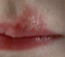 Another cold sore