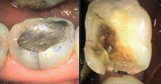 When Teeth Go Bad